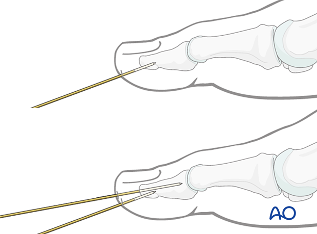 K-wire insertion into the distal phalanx
