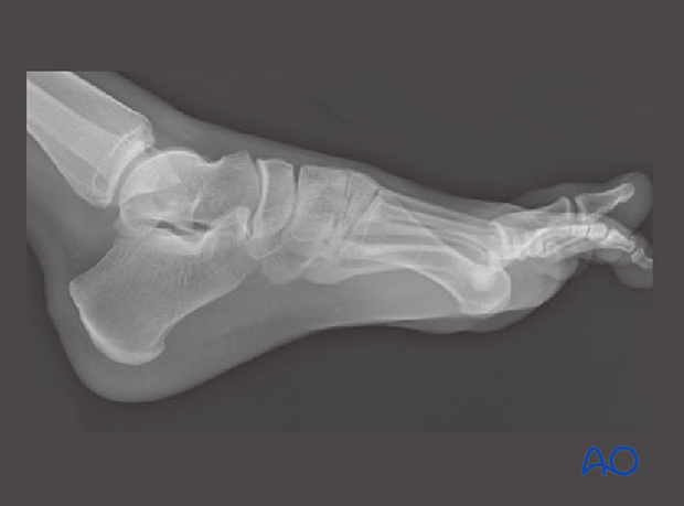 Lateral view of an MTP joint dislocation