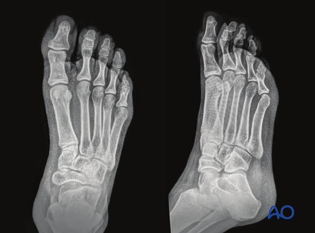 AP and oblique x-rays of a normal foot
