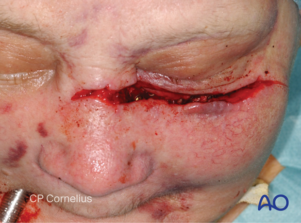 Clinical photograph showing a horizontal lower lid laceration.