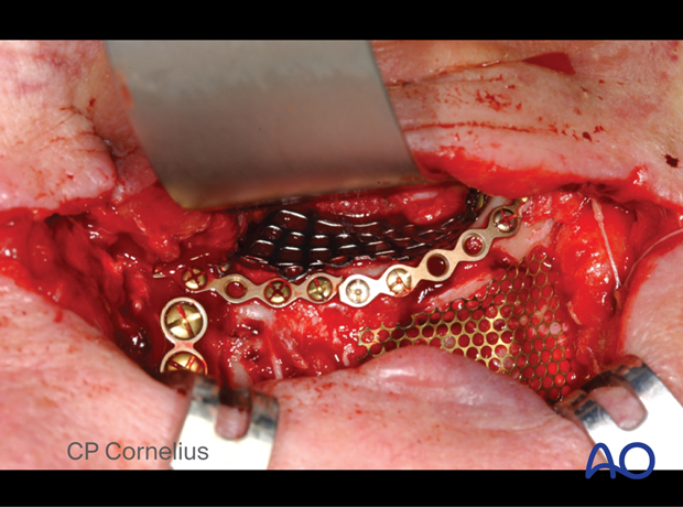 Clinical photograph showing the application of osteosynthesis and orbital mesh plate.