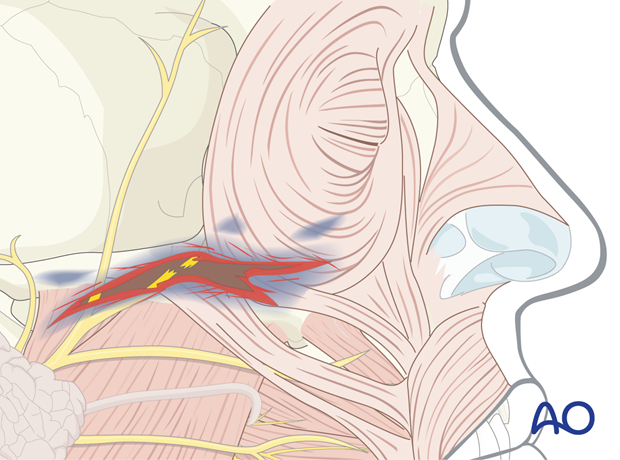 The peripheral facial nerve branch is affected by a laceration.