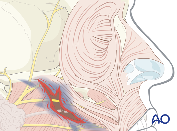 Parotid duct injury.