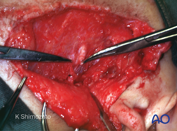 Clinical photograph showing use of extending existing lacerations to explore the parotid duct.