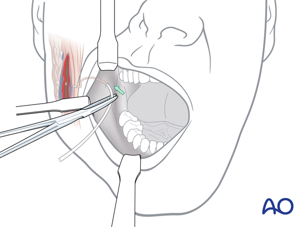 Repair of the parotid duct using silicone rubber tubing to stent the duct laceration.