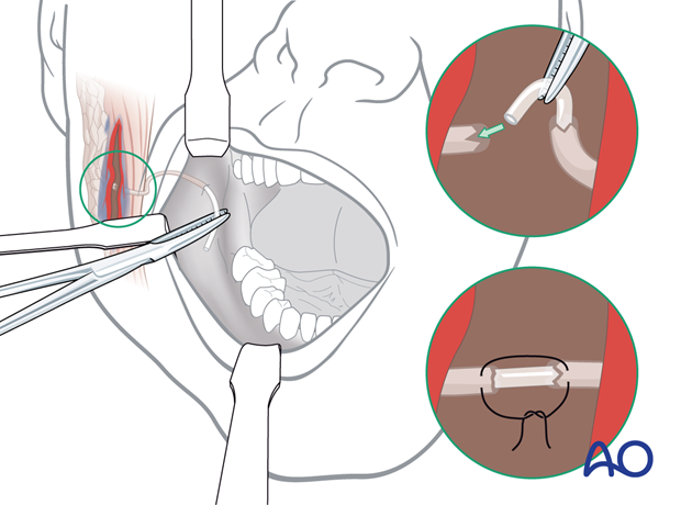 Reapproximating and suturing the edges of the parotid duct over the stent using microsurgical instrumentation.