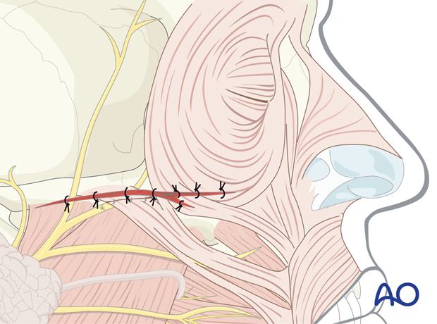 Wound closure of an extended laceration.