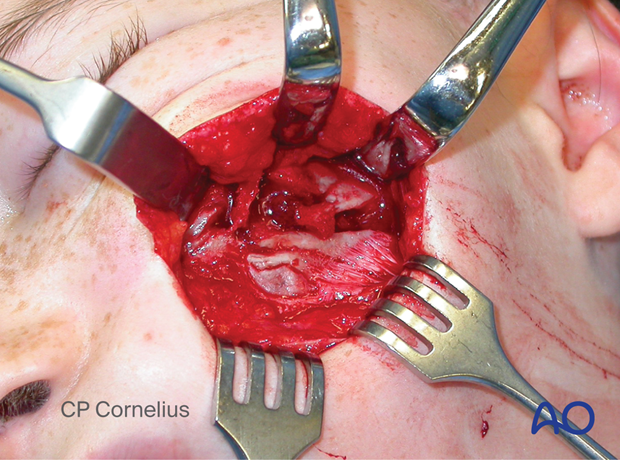 Clinical photograph showing the underlying multifragmentary zygoma revealed by elevating the soft tissues.