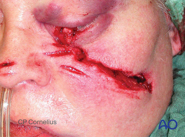 Clinical photograph showing the soft-tissue laceration after a chain saw injury.