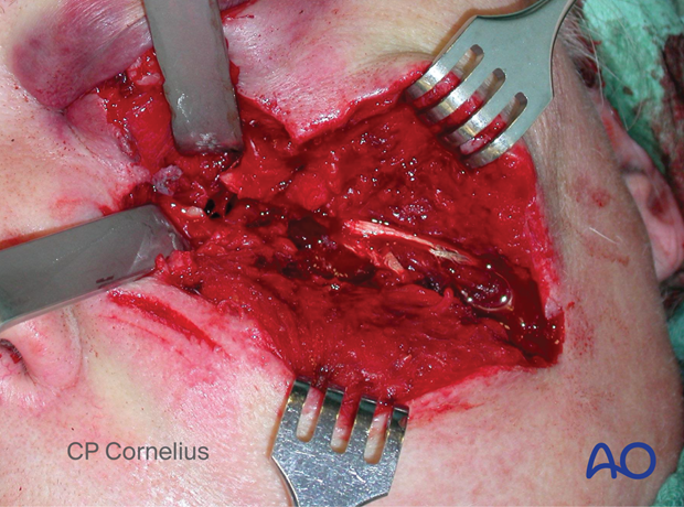 Clinical photograph showing the underlying multifragmentary fracture of the infraorbital rim and the orbital floor.