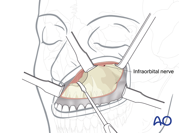 Submucosal dissection of nasal cavity.