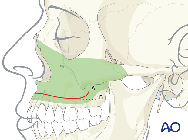 buccal sulcus approach