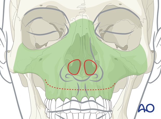 Approaches to the maxilla