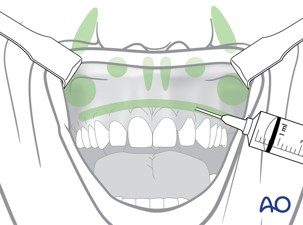 Maxillary vestibular approach