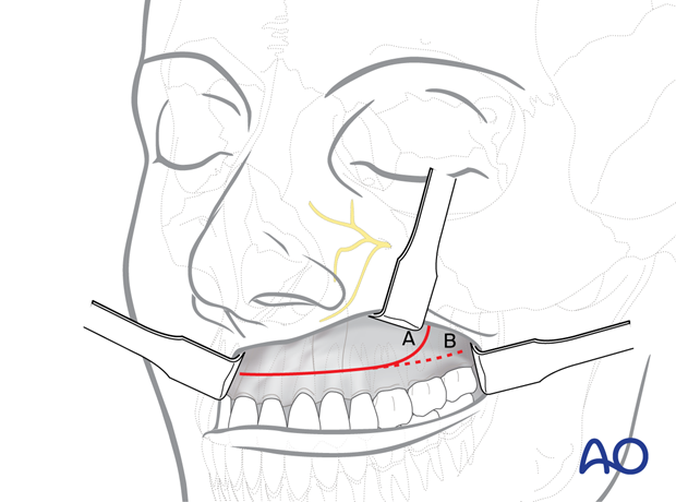 Maxillary vestibular approach