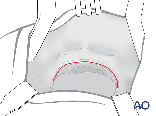 Maxillary vestibular approach