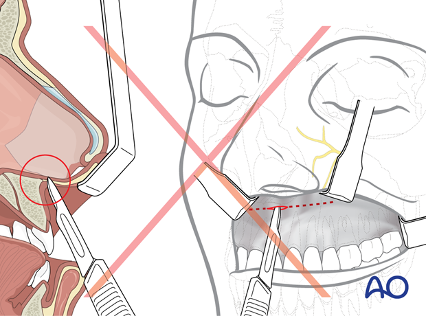 Maxillary vestibular approach