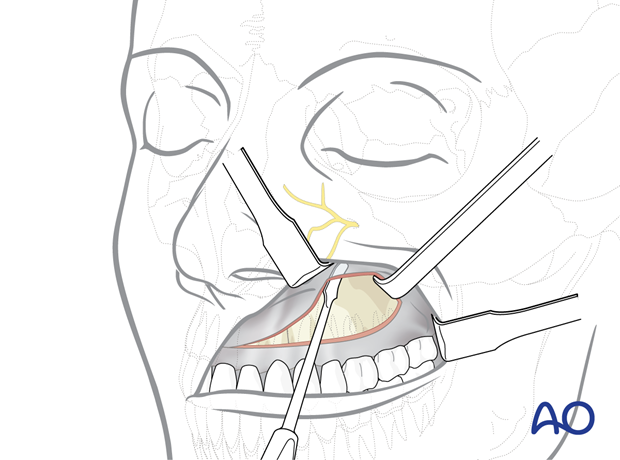 Maxillary vestibular approach