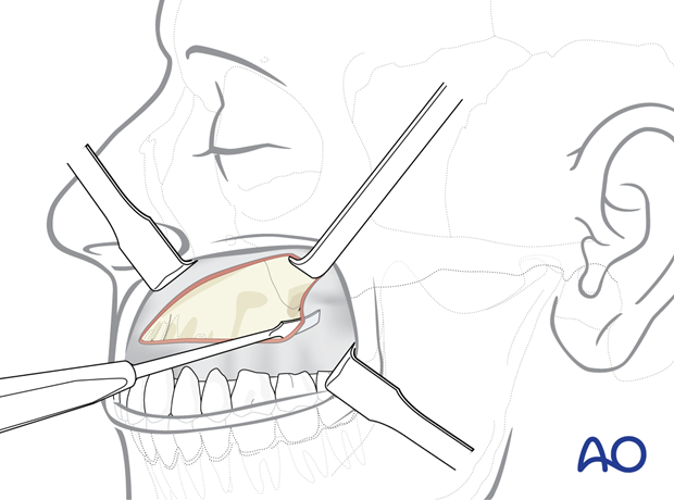 Maxillary vestibular approach