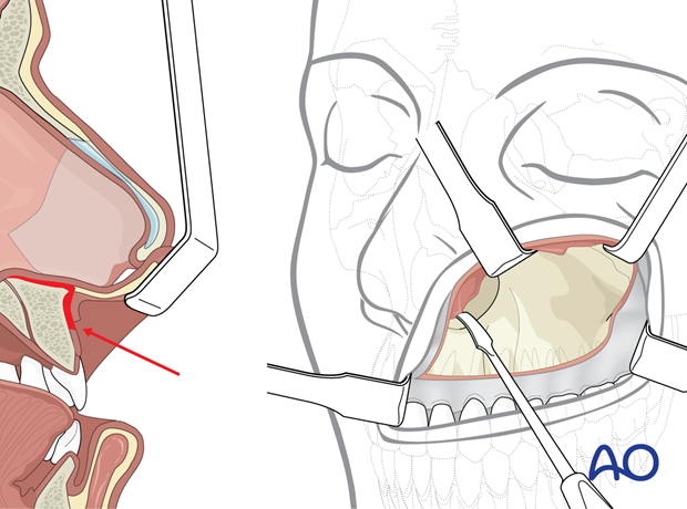 Maxillary vestibular approach