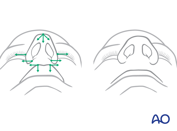 Maxillary vestibular approach