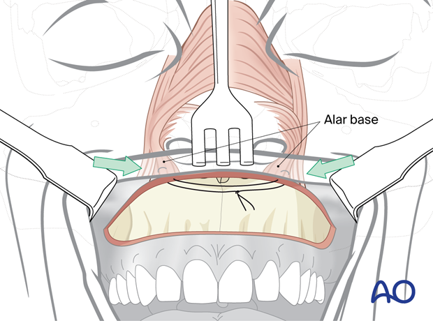 Maxillary vestibular approach