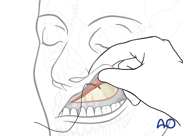 Maxillary vestibular approach