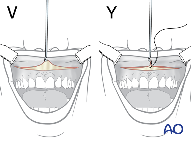 Maxillary vestibular approach