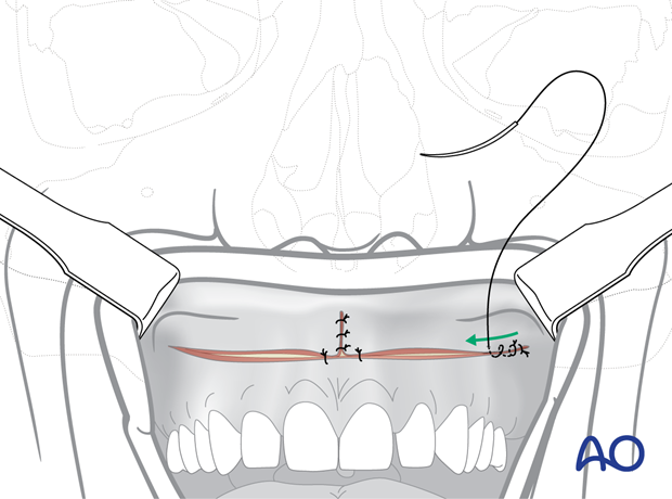 Maxillary vestibular approach