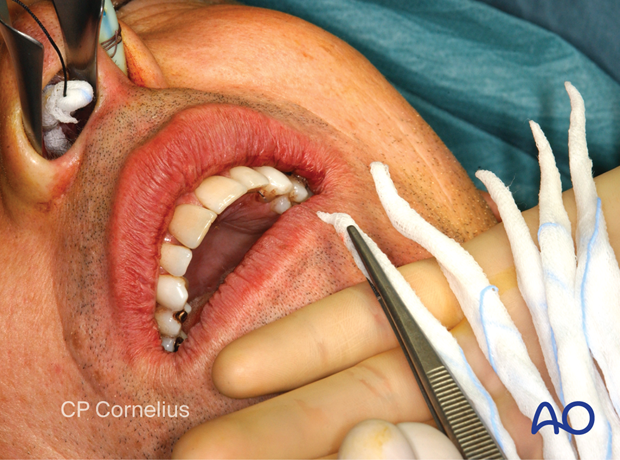 Maxillary vestibular approach