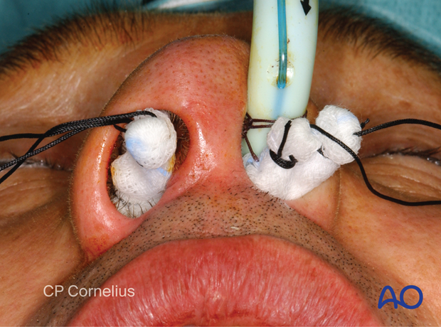 Maxillary vestibular approach