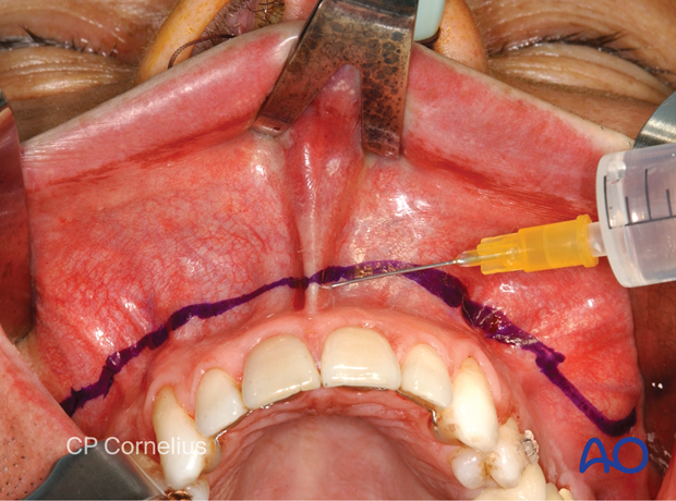 Maxillary vestibular approach