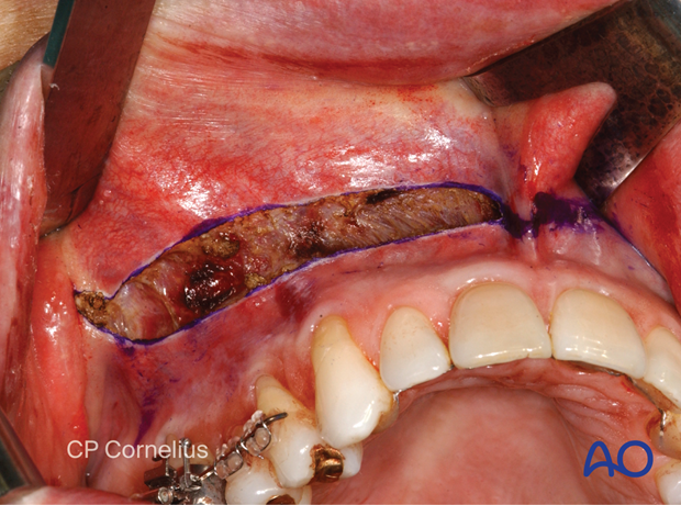 Maxillary vestibular approach