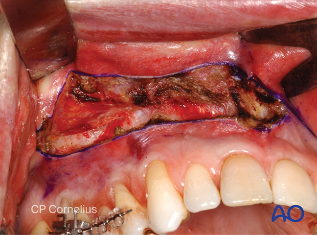 Maxillary vestibular approach