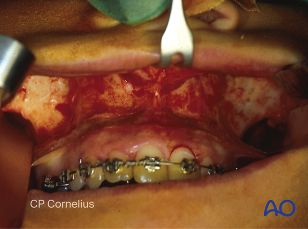 Maxillary vestibular approach