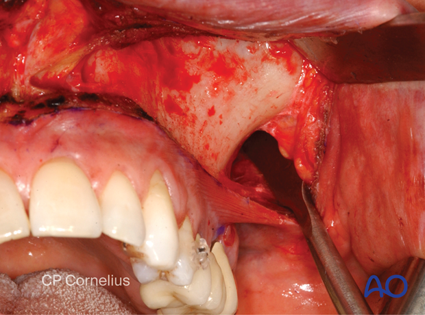 Maxillary vestibular approach