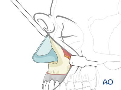 Midfacial degloving approach