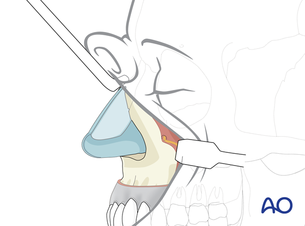 midfacial degloving approach