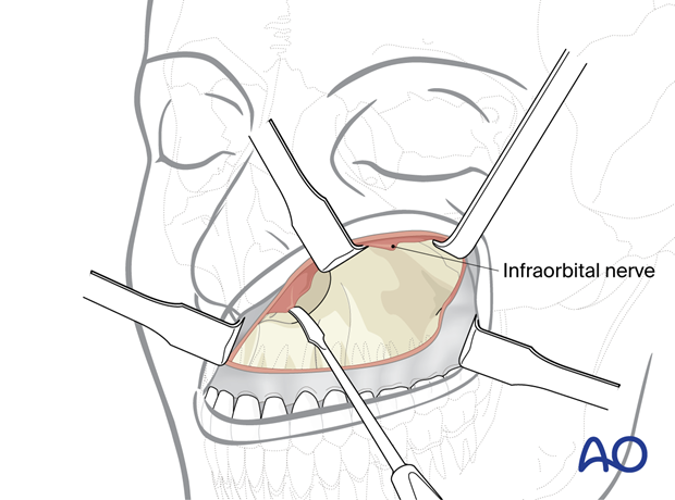 midfacial degloving approach