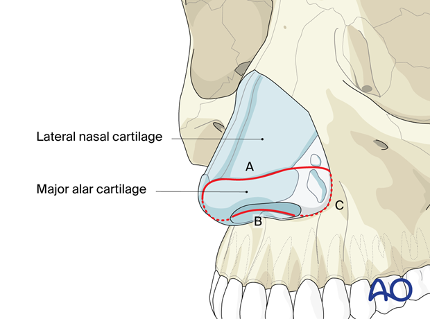 midfacial degloving approach