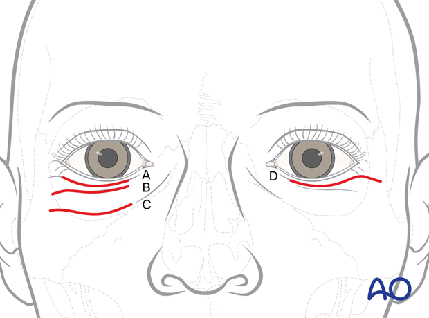 Basic incision lines – transcutaneous lower-eyelid approach.