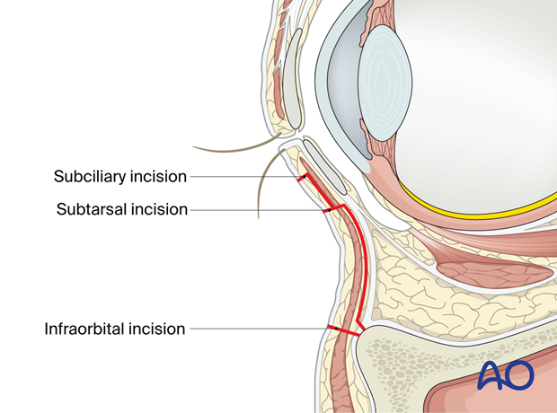 Incisions lines for transcutaneous lower-eyelid approaches.