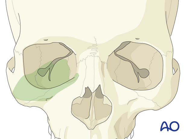 Access to the lower region of the orbital cavity and upper midface via the transcutaneous lower-eyelid approaches.