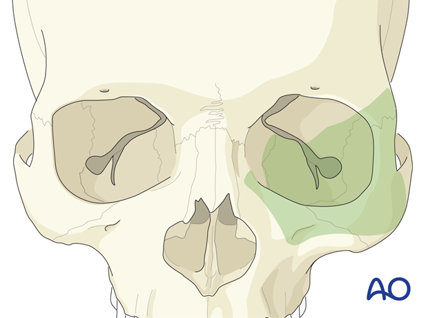 Access to the lower region of the orbital cavity and upper midface via the transcutaneous lower-eyelid approaches.