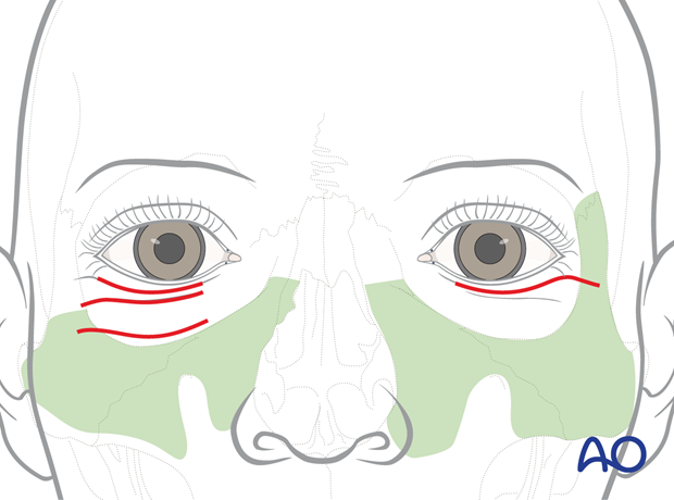 Area of bone exposure inferomedial of the infraorbital rim and across the zygomatic eminence – transcutaneous lower-eyelid approach.