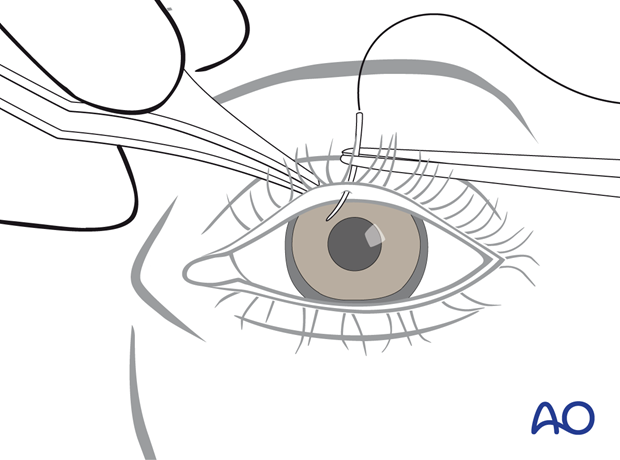 Temporary tarsorrhaphy using a mattress suture – transcutaneous lower-eyelid approach.