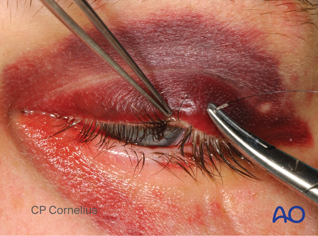 Clinical photograph showing suture passing through the skin of the upper eyelid during temporary tarsorrhaphy – transcutaneous lower-eyelid approach.