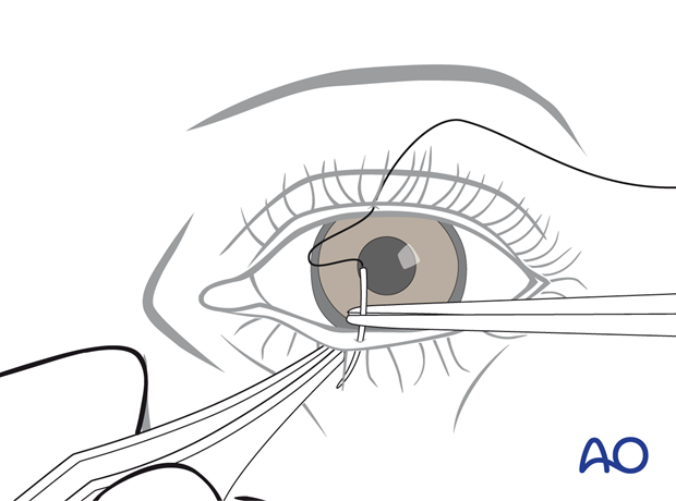 Needle passing through Gray line of the lower eyelid during temporary tarsorrhaphy – transcutaneous lower-eyelid approach.