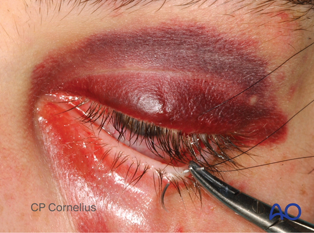 Clinical photograph showing the needle passing through Gray line of the lower eyelid during temporary tarsorrhaphy – transcutaneous lower-eyelid approach.