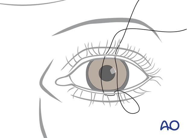 Completing the mattress suture during temporary tarsorrhaphy – transcutaneous lower-eyelid approach.